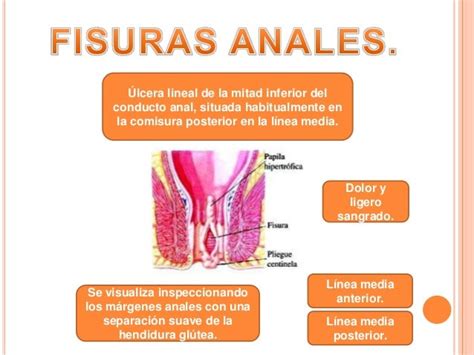 falladas anales|Fisura anal .